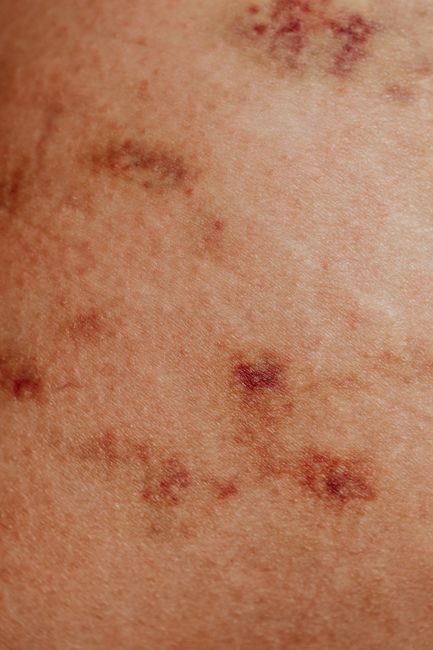 Qu’est-ce que l’inflammation chronique de bas grade ? Qu'est-ce que l'inflammation chronique de bas grade ? – consultation nutritionniste